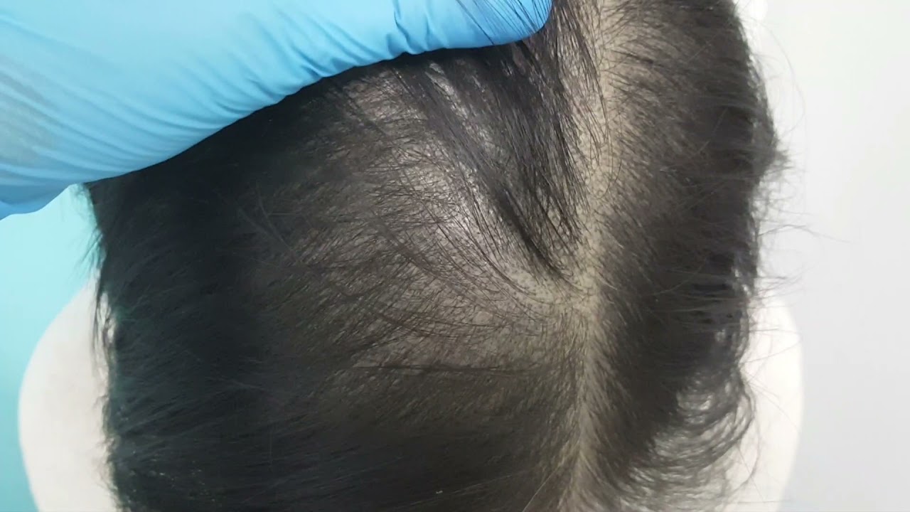 Healed 2 sessions Medical SMP Scalp Micropigmentation density by El Truchan @ Perfect Definition