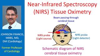 Near Infrared Spectroscopy (NIRS) Tissue Oximetry