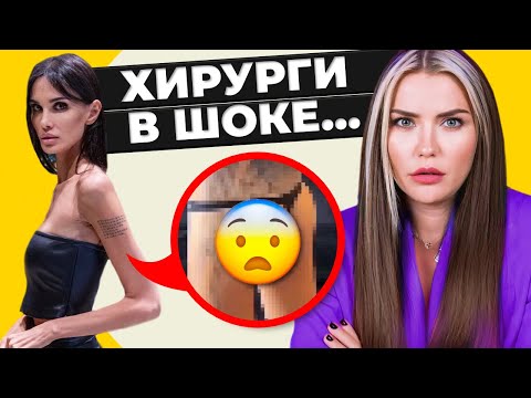 ЖУТКАЯ ПЛАСТИКА Аланы Мамаевой 😰 чем опасны импланты ягодиц?