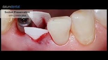 OSSIX VOLUMAX and OSSIX PLUS by Datum Dental   MKT0032 01