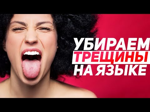 Чем лечить глоссит на языке у взрослых в домашних условиях