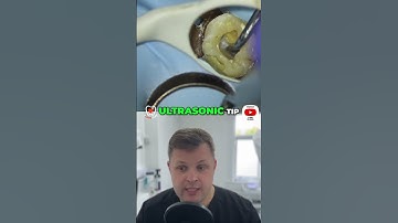 Mastering Glide Path Files  Time Saving Tips for Efficient Root Canal Procedures
