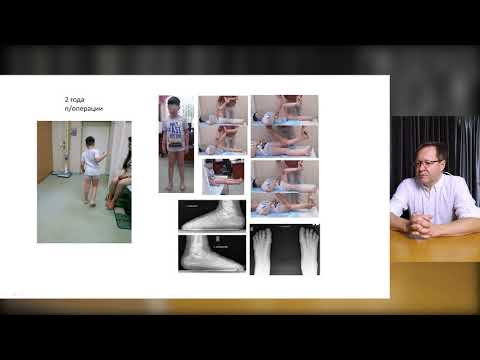 3D анализ походки у пациентов с ДЦП