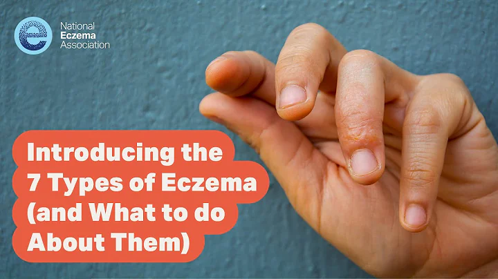 Introducing the 7 Types of Eczema (and What to do About Them)