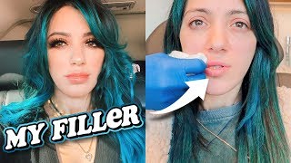 Breaking my silence on my lip filler niki 検索動画25 Breaking my silence on my lip filler niki 検索動画 25