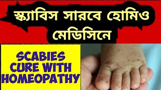 হোমিওপ্যাথিতে স্ক্যাবিস মুক্তি/Scabies Homeopathic Treatment#viralvideo#BIOHOMEOWORLD#Homeopathi#yt