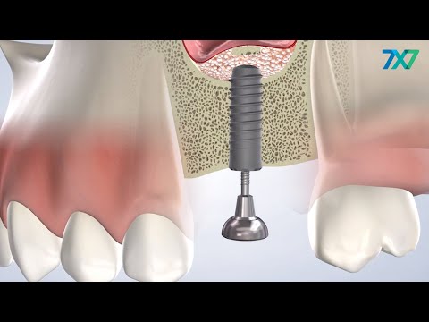 Bone Grafts in San Francisco, CA | 7x7 Dental Implant & Oral Surgery Specialists