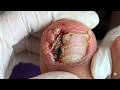 Wow, Super Thick Onychomycosis Requires Careful Trimming! #toenails  #5