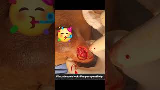 Fibroadenoma ( Left breast) surgery: Lumpectomy