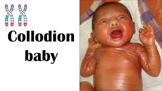 Collodion Baby   Causes, Risk Factors, Complications, & Treatment