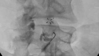 Right L4/5 Facet Injection Under Fluoroscopy - ThePainSource.com