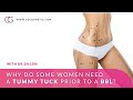 Why a tummy tuck prior to a BBL? with Dr.Dillon at CG Cosmetic Surgery