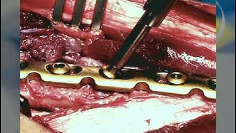 Locking Compression Plate (LCP)