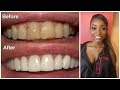 EASY AT HOME TEETH WHITENING + GIVEAWAY (CLOSED)