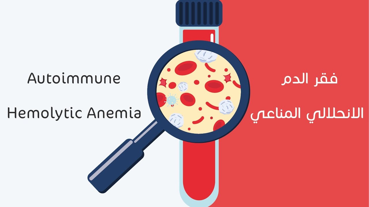 فقر الدم الانحلالي المناعي