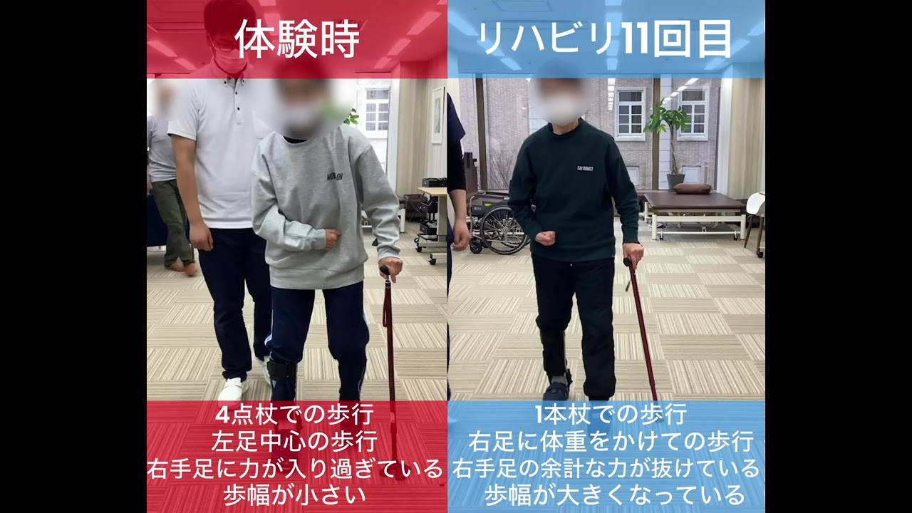 【発症後2年6か月】60代女性・脳出血の改善事例_歩行比較