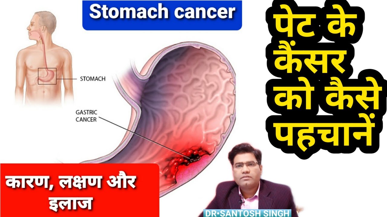 gastric cancer ke lakshan