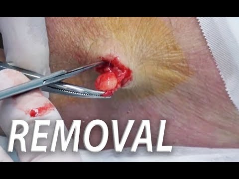 Double Lipoma Removal!  Cysts, Boils, Pimple and Acne!