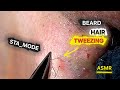 Satisfying Ingrown Beard Tweezing ASMR