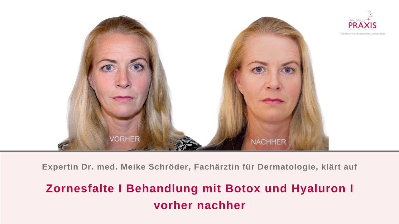 Zornesfalte I Behandlung mit Botox und Hyaluron I Vorher/ Nachher - YouTube