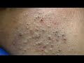 ASMR Blackhead Removal & Deep Pore Cleansing for Glowing Skin