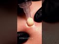 Extreme Macro Pore Extraction — So Clean It’s Unreal 😮 #asmr #vacuum
