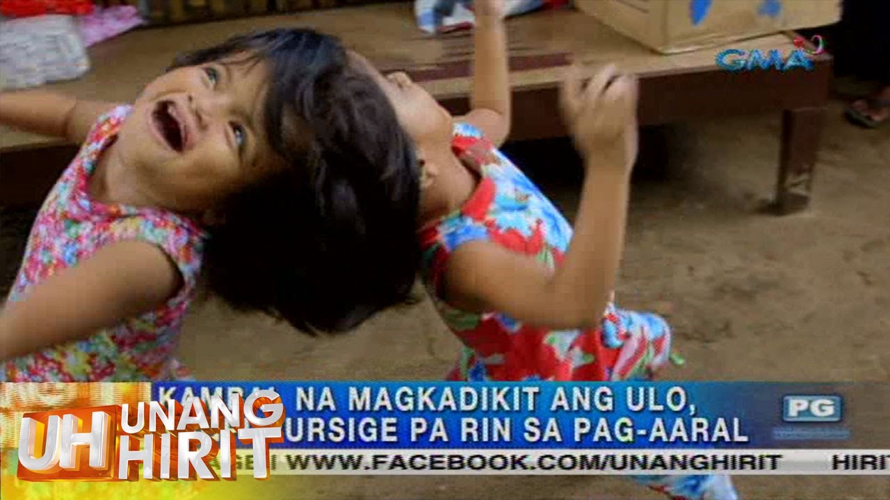 Unang Hirit: Kambal na magkadikit ang ulo, hindi susuko - YouTube