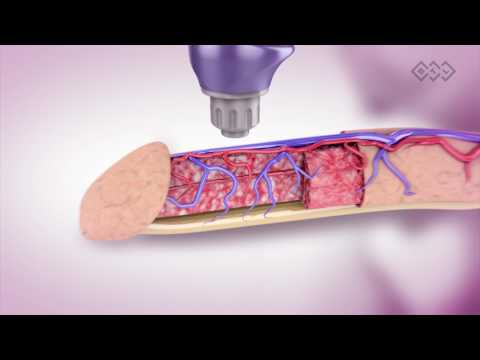 Ударно-волновая терапия BTL при лечении эректильной дисфункции. Визуализация.