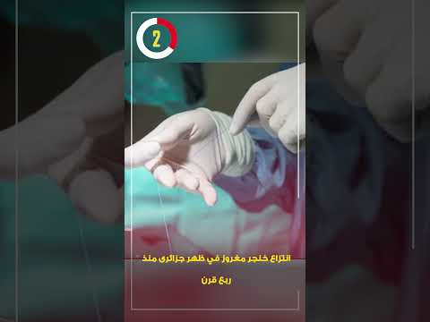 انتزاع خنجر مغروز في ظهر جزائرى منذ ربع قرن