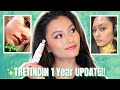 TRETINOIN BEFORE AND AFTER | 1 YEAR EXPERIENCE!!