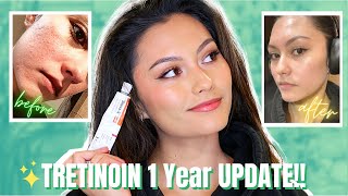 TRETINOIN BEFORE AND AFTER | 1 YEAR EXPERIENCE