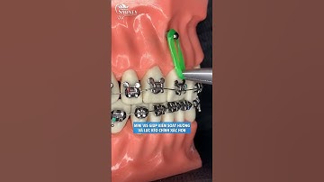 Minivis niềng răng sử dụng trong trường hợp nào? #niengrang #dentist #nhakhoahanoisydney #trend #typ