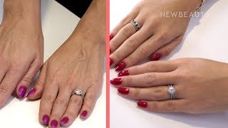 Hand Rejuvenation and Filler I Between the Before and After Ep. 1 | NewBeauty screenshot 5