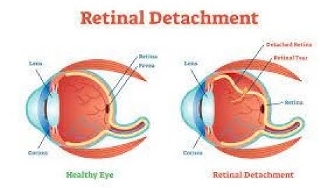 Repair of retinal detachment CPT code - simplify medical coding