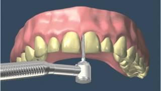 Preparación y colocación de carilla en Central - Estética Dental