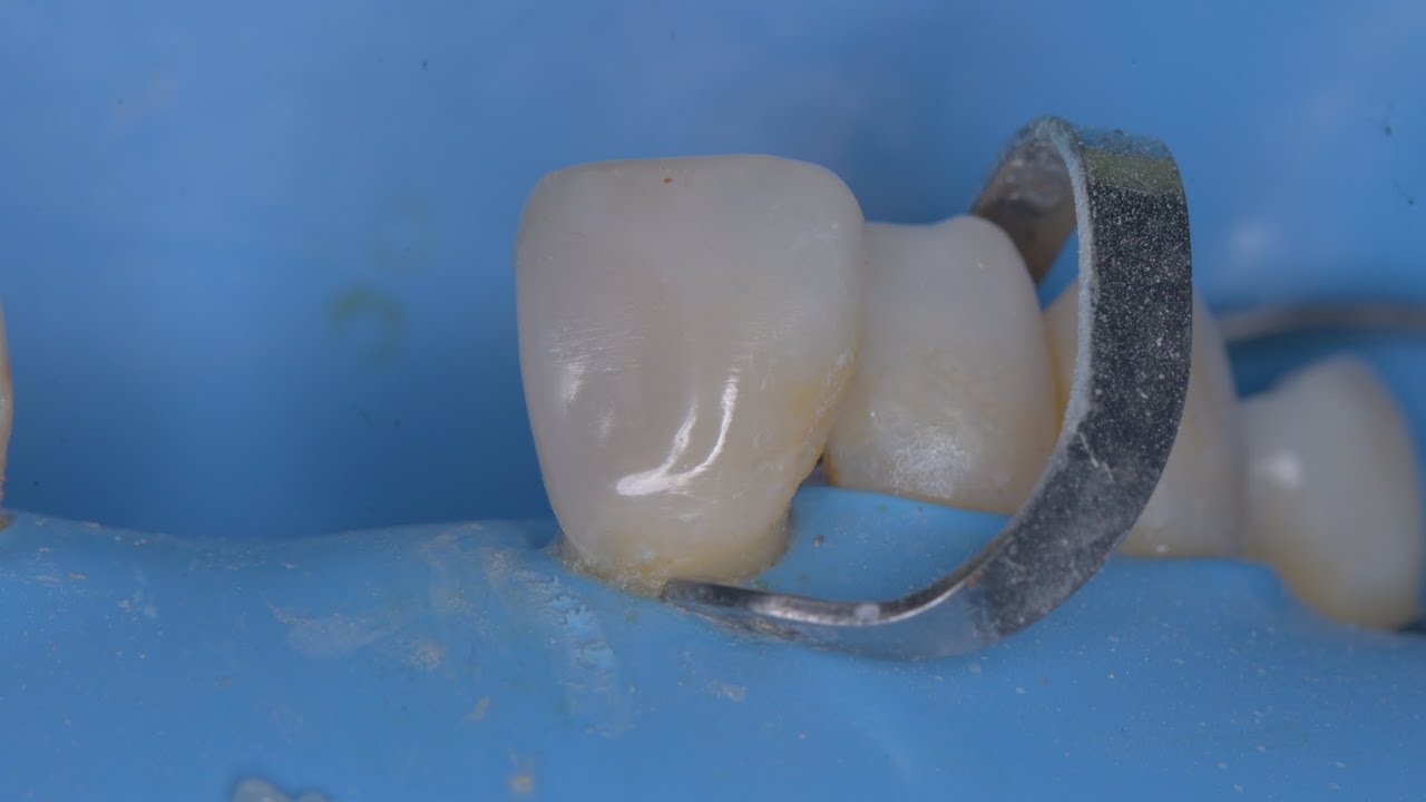 Anterior Restoration after rct ( a throwback case) - YouTube