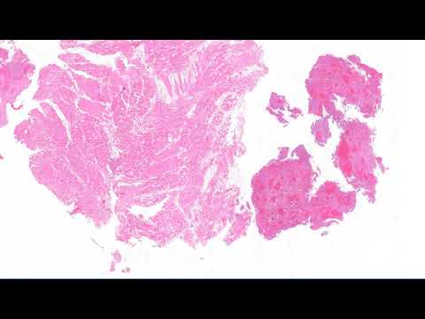 Video: Arginase-1 Imuninio Dažymo Diagnostinė Reikšmė Diferencijuojant Hepatoceliulinę Karcinomą Nuo Metastazavusios Ir Cholangiokarcinomos, Palyginti Su HepPar-1