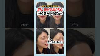 악건성피부, 거친 피부결, 피부장벽 무너졌을때 피부회복 이거면 됨! #건조한피부 #피부시술