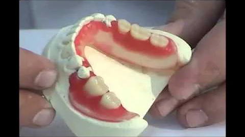 Como é feito a prótese flexível?