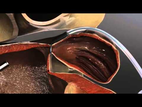 left atrial appendage exclusion youtube