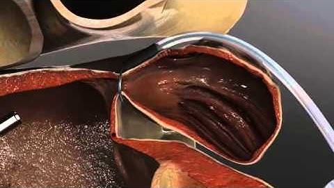 Left Atrial Appendage Exclusion Animation