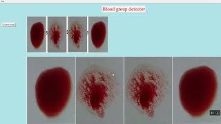 Blood Group Detection In Python Projects