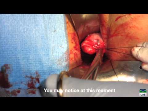 Treatment of Ectopic Pregnancy Through Posterior Colpotomy