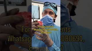 Hip Collapse Due to Bilateral AVN | Treated with Bikini MIS DAA Technique | In Delhi, NCR