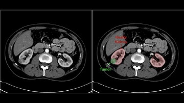Kidney Segmentation | +91-9872993883 for query |Implementation of Ultrasound Images Neural Network |