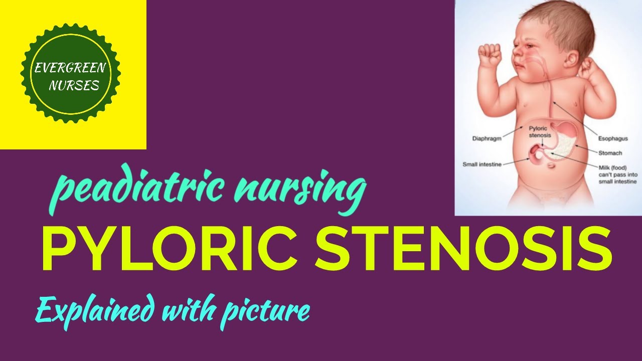 PYLORIC STENOSIS IN BABIES YouTube