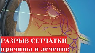 Разрыв сетчатки глаза - причины и лечение (лазерная коагуляция)