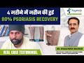 Psoriasis Winter Flare Control कैसे करें? | Real Patient Result | psoriasis treatment India