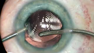 Implantation Video of Acriva Trinova screenshot 1