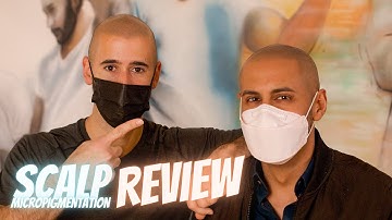 INSANELY NATURAL Scalp Micropigmentation Result with Matt Iulo